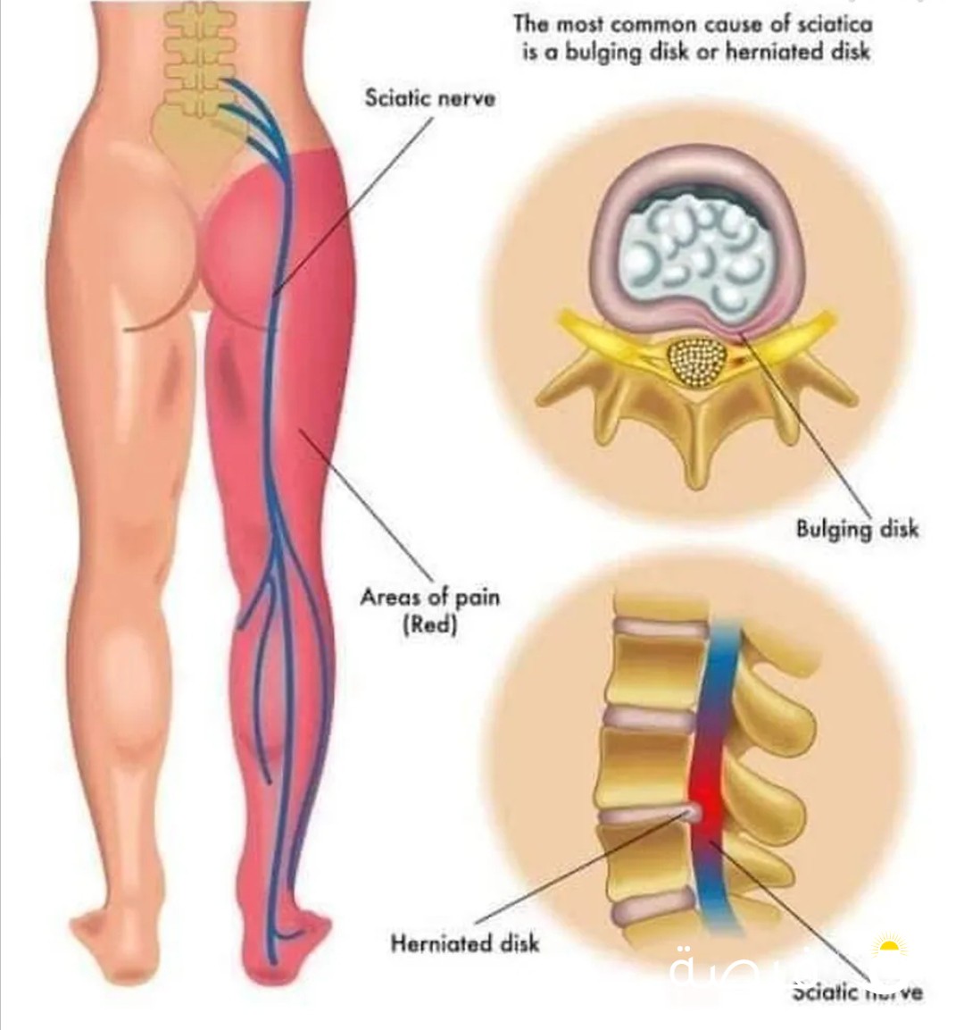 الحجامة معجزة العصر