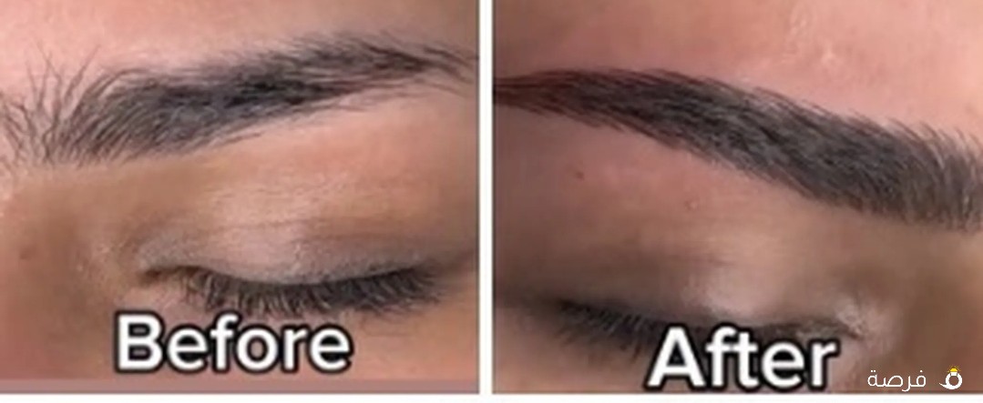 Eyebrow micro balding